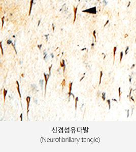 신경섬유다발 (Neurofibrillary tangle)