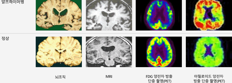 알츠하이머병과 정상 뇌조직 비교 이미지