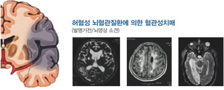 허혈성 뇌혈관질환에 의한 혈관성치매 (발명기전/뇌영상 소견)