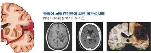 출혈성 뇌혈관질환에 의한 혈관성치매 (발명기전/뇌영상 및 뇌조직 소견)